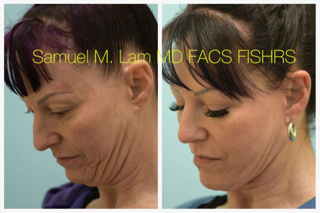 Dallas Cosmetic Rhinoplasty Before and After Photos Plano Plastic