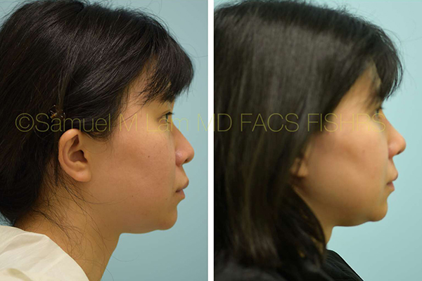 Asian Rhinoplasty