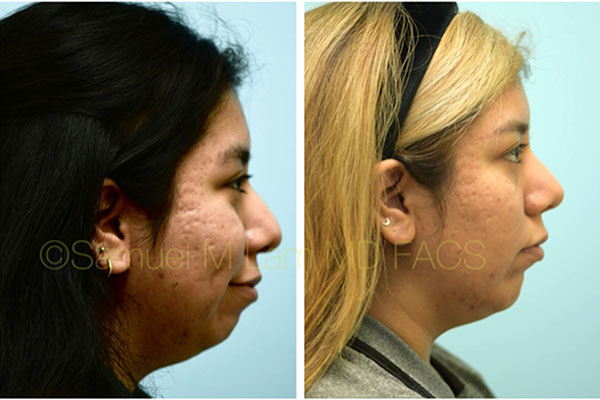 Hispanic Rhinoplasty