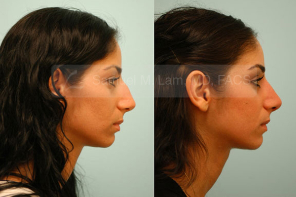 Middle Eastern Rhinoplasty