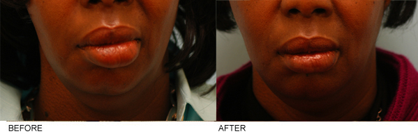 African-American Lip Reduction