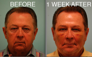 DALLAS FACE LIFT (FACELIFT), FAT GRAFTING, CHIN IMPLANT, BLEPHAROPLASTY